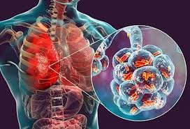 What are the Symptoms of pneumonia