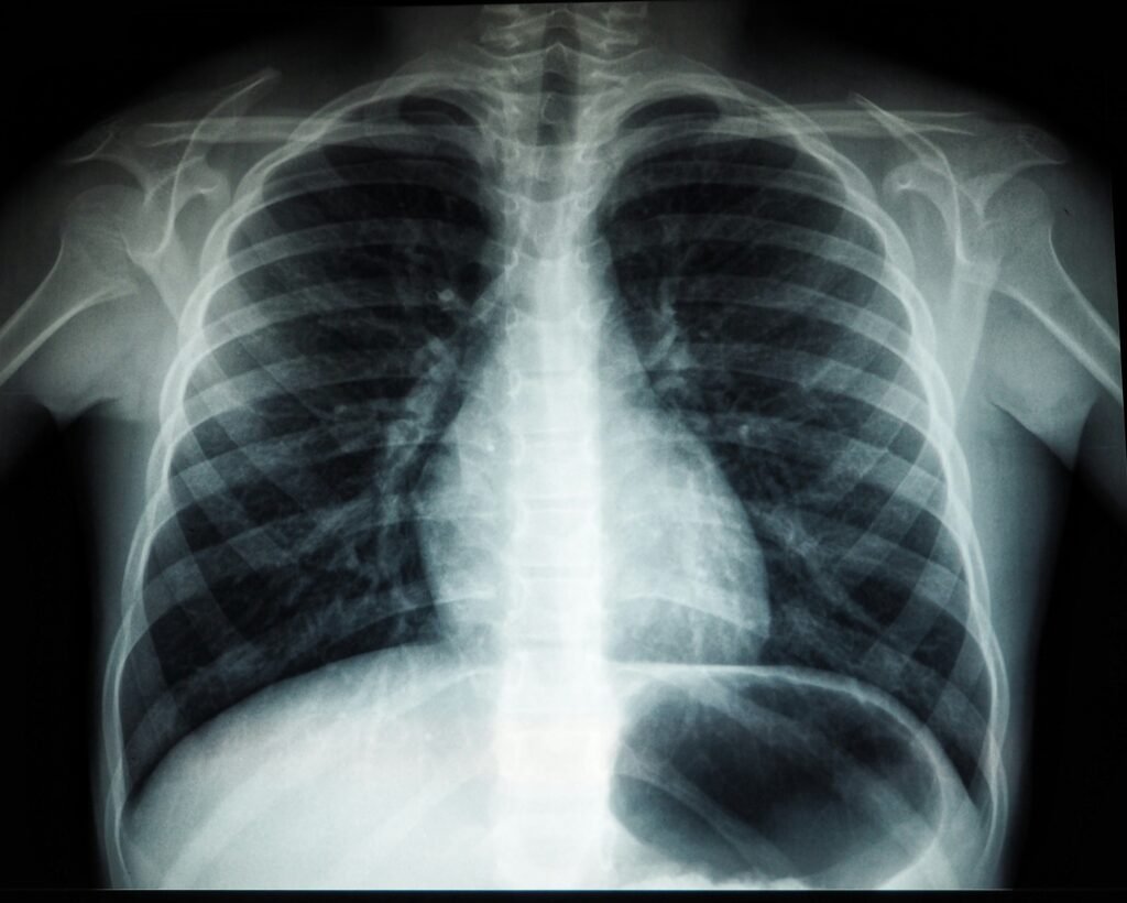  What is Walking Pneumonia