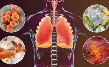 If You Have Walking Pneumonia