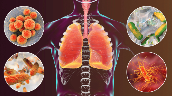 If You Have Walking Pneumonia